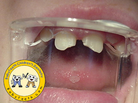 Restoration of Fractured Teeth