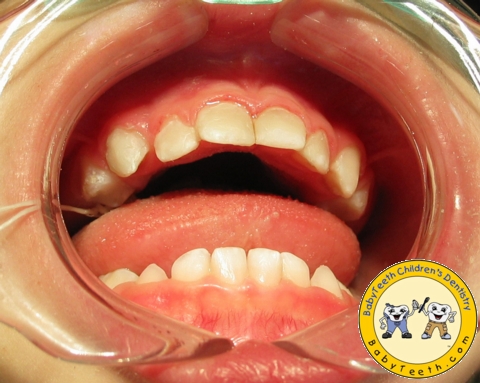 After Photo: Anterior Resin Veneers